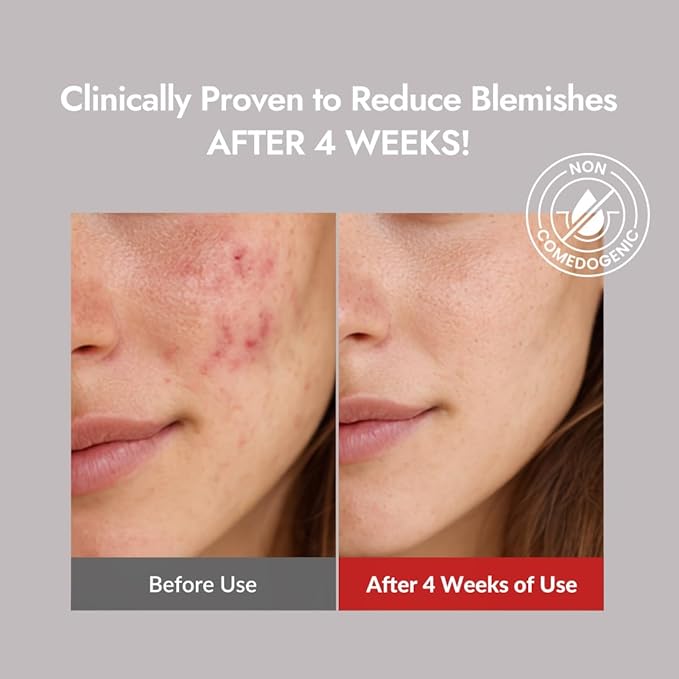 MIZON Goodbye Blemish Fresh Toner, BHA, Niacinamide for Excessive Sebum, Troubled Skin, Acne Treatment, Breakout Treatment, Korean Skincare, Acne Spot Treatment, Smooth Skin (120ml/4.05 fl. oz.)