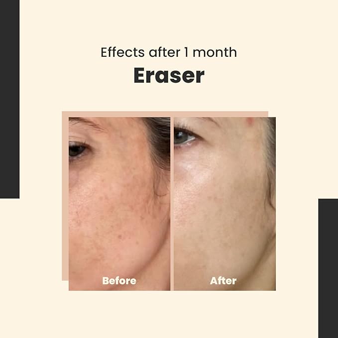 Eraser - Powerful Serum for Hyperpigmentation with 10% Vitamin C, For Dark Spots & Redness Reduction – Vegan – Safe for Daily Use – 30 ml/Net 1.01 Fl. Oz