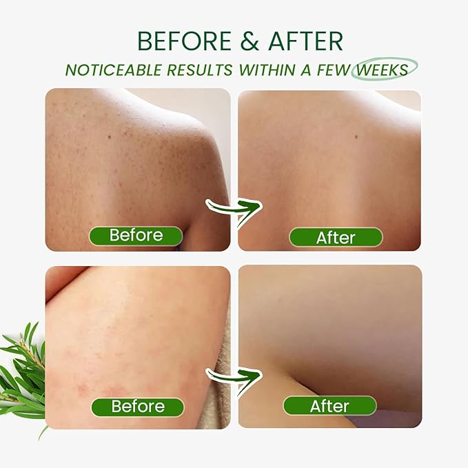 Tea Tree Antifungal Body Wash – Soothes Folliculitis, Acne, Jock Itch, Athlete’s Foot, Ringworm, Tinea Versicolor, Body Odor, Eczema & Dermatitis-Prone Skin