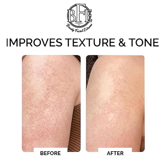 Keratosis Pilaris Exfoliating Body Lotion– 12% Lactic Acid. Provides Immediate Moisture & Gentle Exfoliation to Treat symptoms Associated with Keratosis Pilaris (KP) & Dry, Bumpy Skin Conditions.