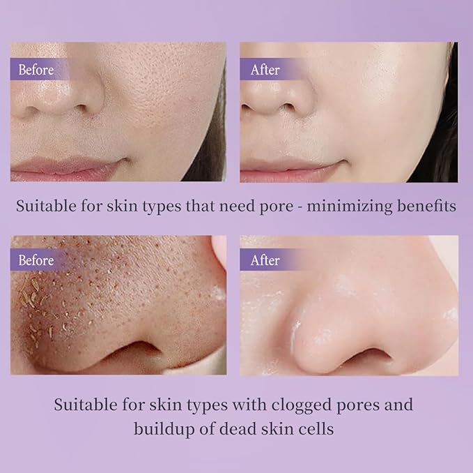 AHA BHA Exfoliating Gel, Deep Cleansing Peeling Gel for Acne Prone Skin, Removes Dead Skin Cells, Minimizes Pores, Renews Skin, Facial & Body Scrub, 2.03 fl oz