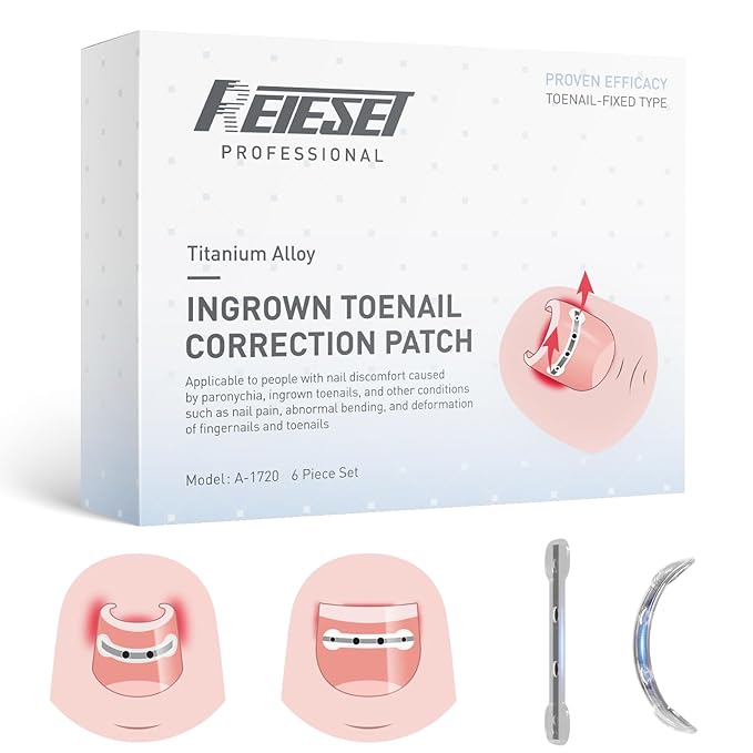 Titanium Alloy Ingrown Toenail Treatment, Nail Tools, and Ingrown Toenail Removal Kit Specially Designed for Curved Nail Repair and Ingrown Toenail Corrector (0.59/0.67in)