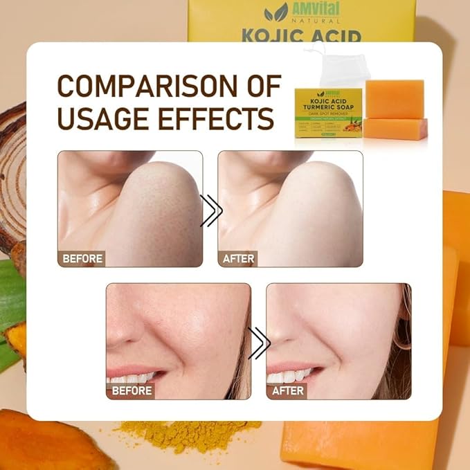 Turmeric Kojic Acid Soap Bars with Vitamin C, Retinol & Hyaluronic Acid – Face & Body Soap with Collagen & Shea Butter – 4-Pack Cleansing Bars for All Skin Types