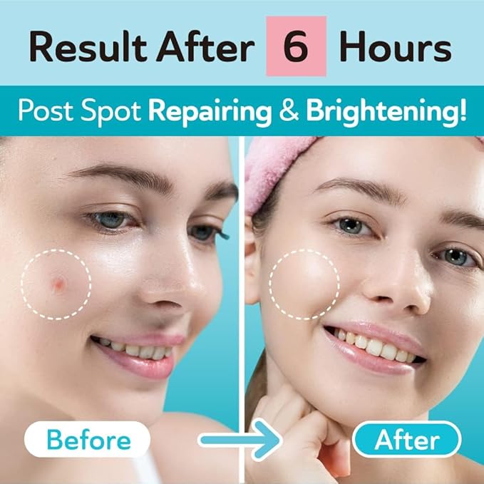 DERMA ANGEL Ultra Invisible Acne Patches for Cystic Acne Treatment Pimple Patches for Cystic Acne Blemish Patches Hydrocolloid Patches - Day & Night Use - UPGRADED (Acne Specialist 48 Count 3 Sizes)
