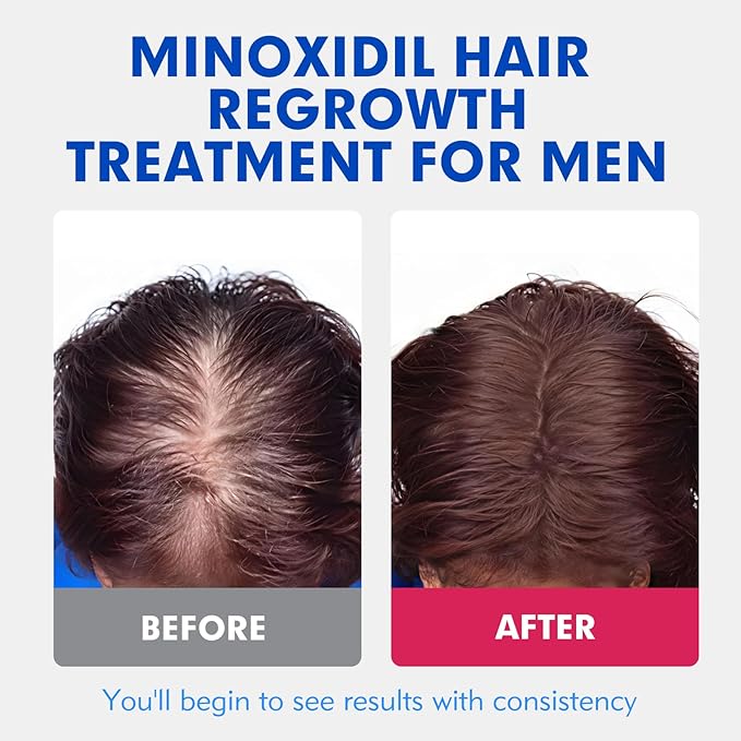 Fytikal 5% Minoxidil for Men Hair Regrowth Treatment, Extra Strength Topical Solution for Thinning Hair & Balding, Beard Growth Enhancer, Non-Greasy Fast-Absorbing Formula, 3-Month Supply
