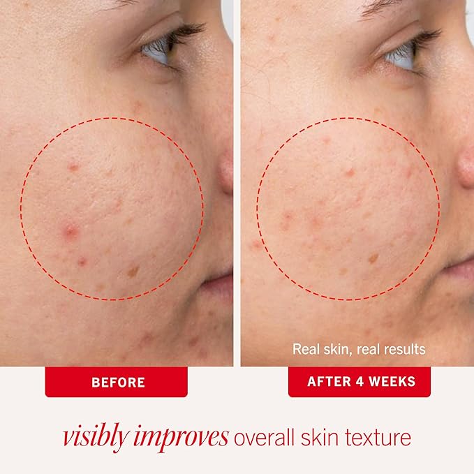 First Aid Beauty Acne Pads for Face - Maximum Strength Acne Treatment - 2% Salicylic Acid Pads Treat Without Drying, (60-ct)