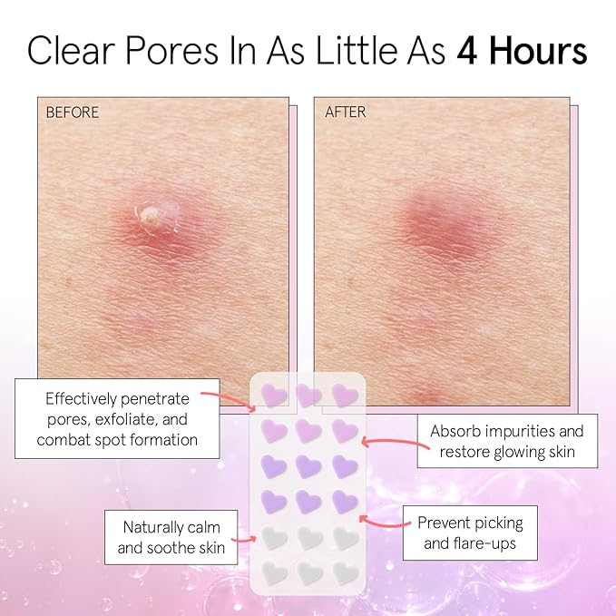 grace & stella Award Winning Pimple Patches for Face - Dermatologist Tested Acne Patches - Hydrocolloid Patch for Breakouts, Whiteheads - Vegan Acne Spot Treatment for Face (Hearts, 216 Pack)
