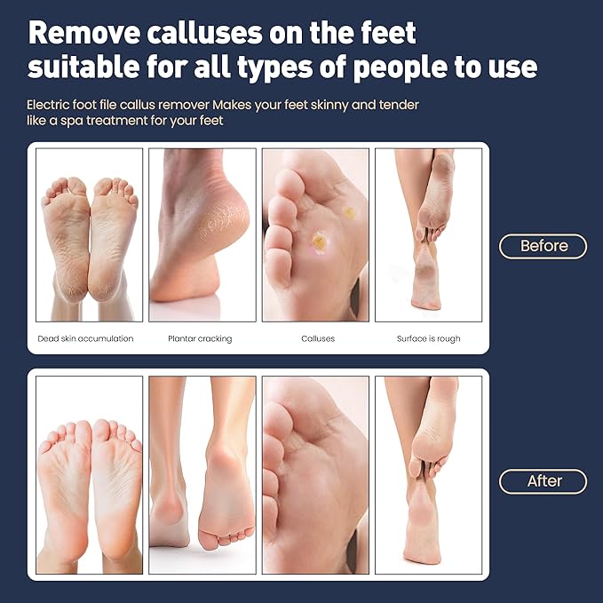 Electric Foot Callus Remover,2 in1 Rechargeable Callus Remover for Feet,9-Speed Cordless Electric Foot File Nail Grinder,Foot Scrubber Pedicure Tools for Dead Skin Dry Cracked Feet (Gold MINI)