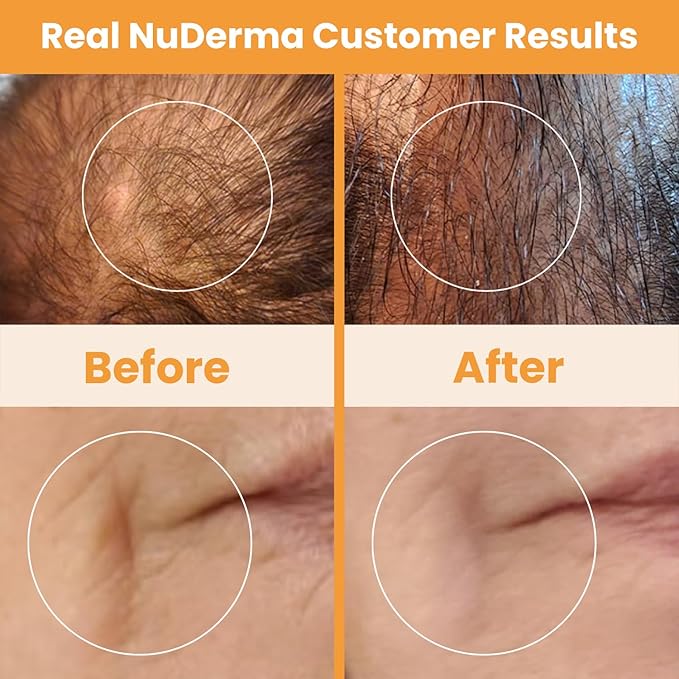 Pure Daily Care NuDerma Handheld Skin Therapy Wand Machine w/Neon – Anti-Aging - Skin Tightening - Wrinkle Reducing - Dark Circles – Clarifying - Hair & Scalp Stimulator (Pack of 2)