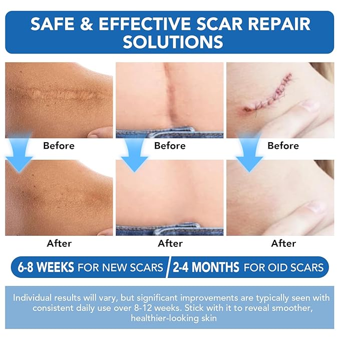 Silicone Scar Sheets, Silicone Scar Tape(1.6"x 200" Roll-5M) - Reusable, Soft & Medical Grade Adhesive Tape for Old & New Scars, C-Section, Surgery, Keloid & Acne Scars