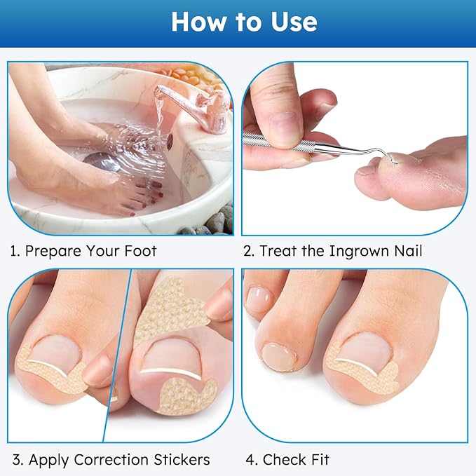 Ingrown Toenail Treatment, No Glue Breathable Curved Toenail Corrector，Ingrown Toenail Corrector Strips with File and Lifter, Professional Nail Correction Stickers 60Pcs