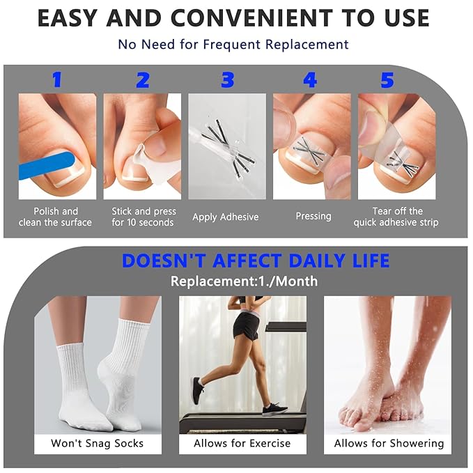 Upgraded MI-shaped Design Titanium Alloy Ingrown Toenail Corrector for Quick Pain Relief, Ingrown Toenail Treatment and Removal Tool Kit for Effective Curved Nail Repair, 6pcs