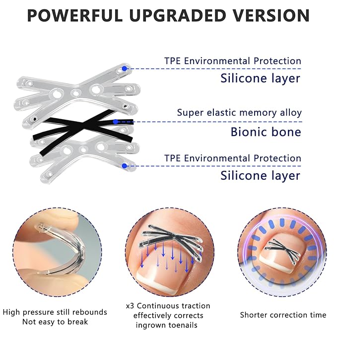 Upgraded MI-shaped Design Titanium Alloy Ingrown Toenail Corrector for Quick Pain Relief, Ingrown Toenail Treatment and Removal Tool Kit for Effective Curved Nail Repair, 6pcs