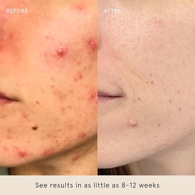 Barefaced Clear Skin Duo - Toning Pads & Toning Pads II - Renew, Resurface and Clear Dull, Dry or Acne-Prone Skin