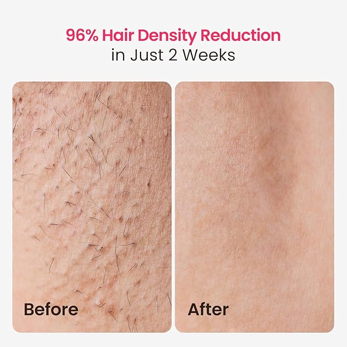 IPL Laser Hair Removal for Women and Men, 25J Triple-Pulse Permanent Hair Removal Device for Ingrown & Coarse Hair, 37°F Painless Sapphire Ice Cooling Hair Removal for Legs, Facial, Armpits, Bikini