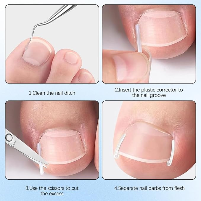 Ingrown Toenail Corrector Set with Correction Strips,Professional Ingrown Toenails Pedicure Tool Set, Toenail Correction Strips & Ingrown Toenail Corrector,Ingrown Nail Tool for Women Man
