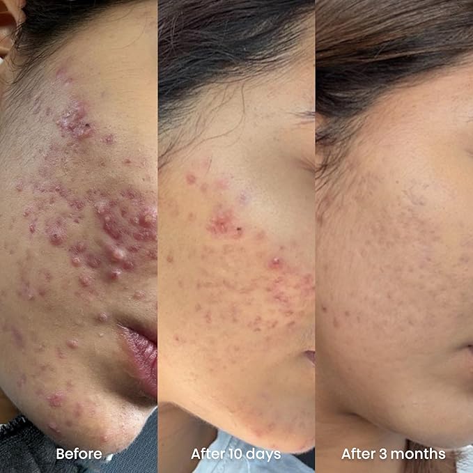 ORBE Derma Solutions Orbe It! 2-Step Acne Treatment – Clears, Treats & Prevents Acne & Helps Unclog Pores with 2% Salicylic Acid – Includes Cleansing Spray 1 oz & Treatment Cream 1 oz