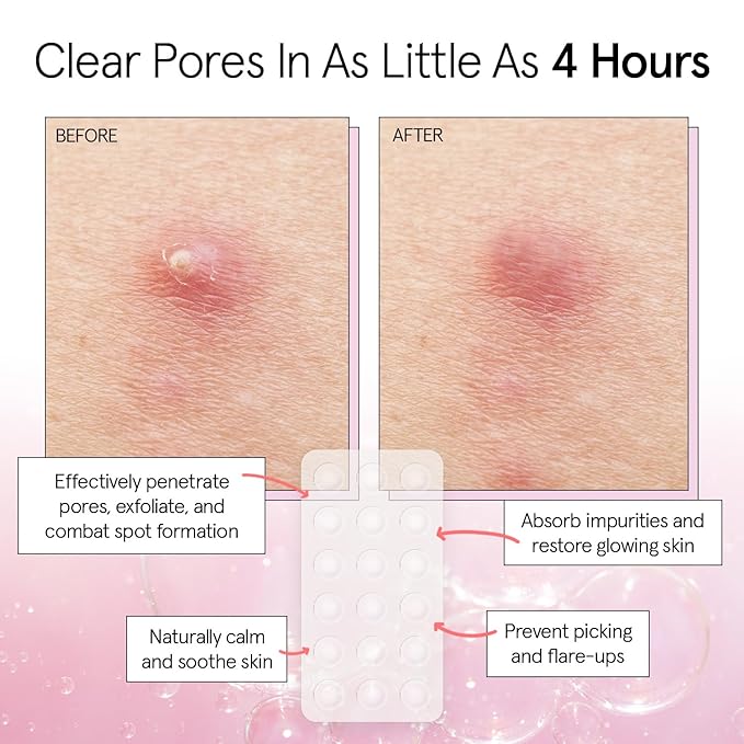 grace & stella Award Winning Pimple Patches for Face - Dermatologist Tested Acne Patches - Hydrocolloid Patch for Breakouts, Whiteheads - Vegan Acne Spot Treatment for Face (Invisible, 216 Count)