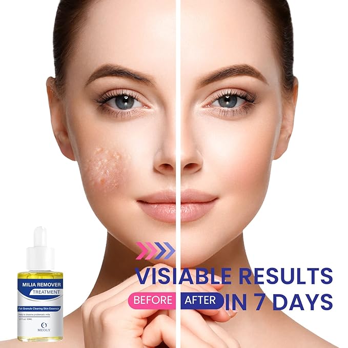 Milia Remover treatment serum, Milia Spot Treatment with Salicylic Acid Milia Acne Serum 25 ML