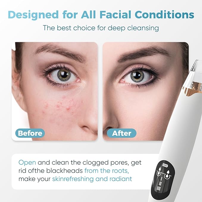 Facial Pore Blackhead Remover Vacuum - Facial Pore Cleaner with 3 Adjustable Suction Levels, 3 Probes, USB Charging Interface - Blackhead Extractor Tools for Women & Men (White)