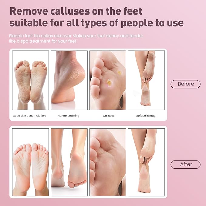 Electric Foot Callus Remover,2 in1 Rechargeable Callus Remover for Feet,9-Speed Cordless Electric Foot File Nail Grinder,Foot Scrubber Pedicure Tools for Dead Skin Dry Cracked Feet(Pink Fold)