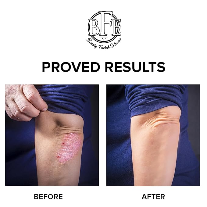 Keratosis Pilaris Exfoliating Body Lotion– 12% Lactic Acid. Provides Immediate Moisture & Gentle Exfoliation to Treat symptoms Associated with Keratosis Pilaris (KP) & Dry, Bumpy Skin Conditions.