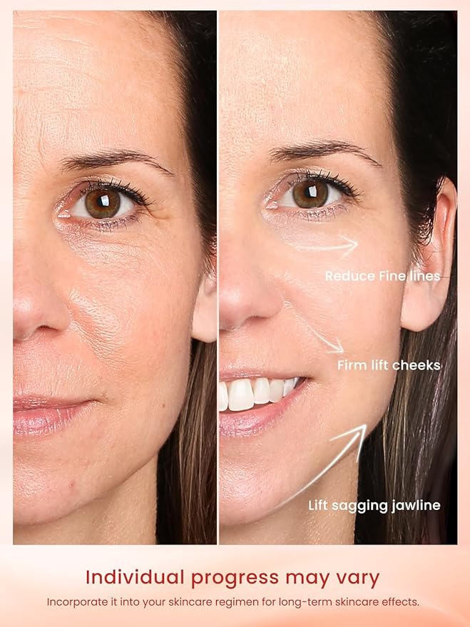 Radio Frequency Skin Tightening Device, RF Face Machine for Anti-Aging, Wrinkle Reduction & Jawline Lifting, Professional Wireless Home Use with 3 Levels