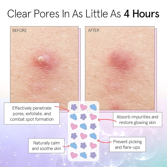 grace & stella Award Winning Pimple Patches for Face - Dermatologist Tested Acne Patches - Hydrocolloid Patch for Breakouts, Whiteheads - Vegan Acne Spot Treatment for Face (Multishape, 216 Count)