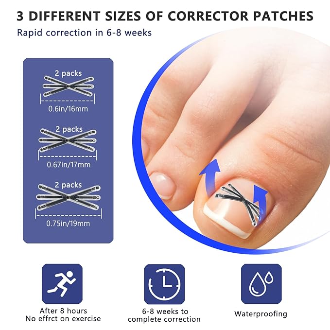 Upgraded MI-shaped Design Titanium Alloy Ingrown Toenail Corrector for Quick Pain Relief, Ingrown Toenail Treatment and Removal Tool Kit for Effective Curved Nail Repair, 6pcs