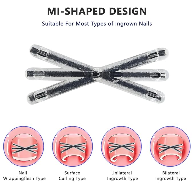 Upgraded MI-shaped Design Titanium Alloy Ingrown Toenail Corrector for Quick Pain Relief, Ingrown Toenail Treatment and Removal Tool Kit for Effective Curved Nail Repair, 6pcs