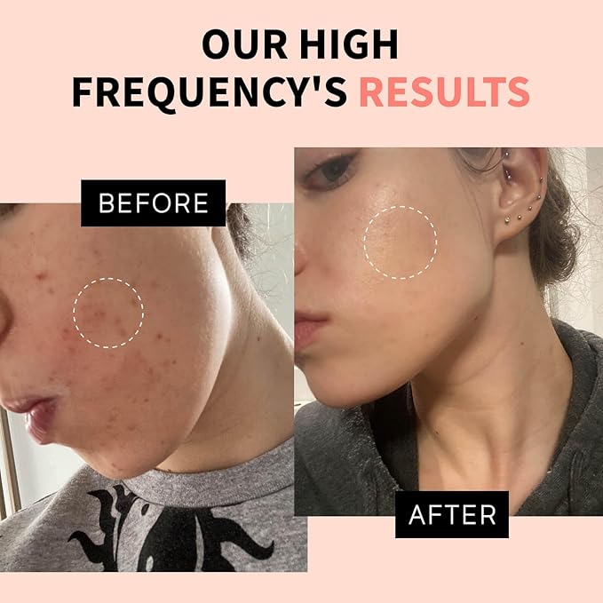 OxyGlow 2 Cordless High Frequency Facial Machine, ProFacialWand Clinical Skin Therapy Wand - Xenon Gas