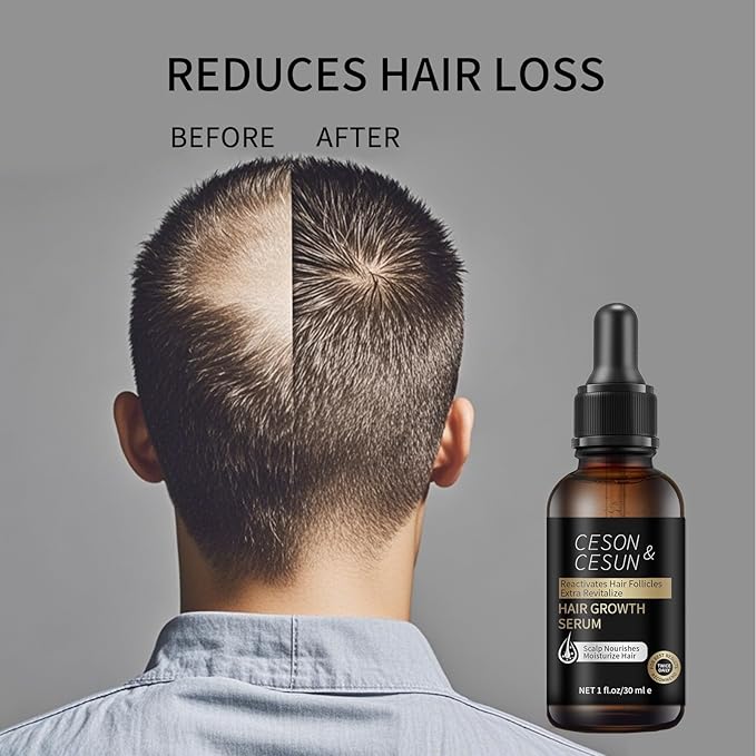 Ceson&Cesun Hair Growth Serum/Scalp Oil - Biotin & Rosemary Castor Oil Treatment for Stronger Thicker Longer Hair, Water-Based – Natural Hair Growth Thickening Treatment for Men & Women