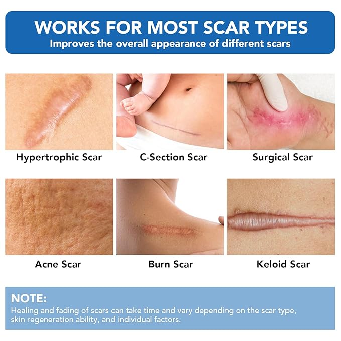 Silicone Scar Sheets, Silicone Scar Tape(1.6"x 200" Roll-5M) - Reusable, Soft & Medical Grade Adhesive Tape for Old & New Scars, C-Section, Surgery, Keloid & Acne Scars