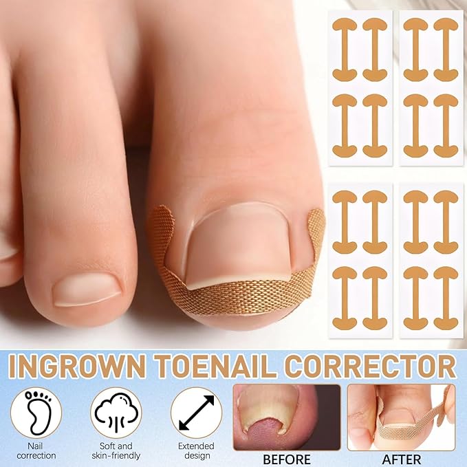 Ingrown Toenail Corrector Set with Correction Strips,Professional Ingrown Toenails Pedicure Tool Set, Toenail Correction Strips & Ingrown Toenail Corrector,Ingrown Nail Tool for Women Man