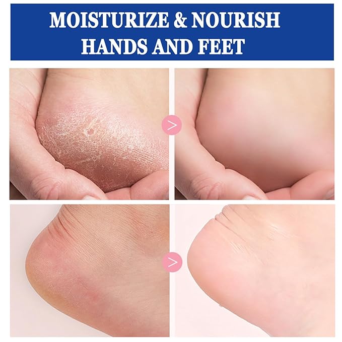 2PCS 60% Urea Cream plus 2% Salicylic Acid Foot Cream, Hydrating and Anti-Cracking Foot Cream, Maximum Strength Urea Foot cream Exfoliates Dead SkinRepairs and Hydrates Dry and Cracked Feet and Hand