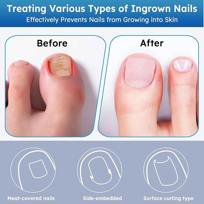 Ingrown Toenail Treatment, No Glue Breathable Curved Toenail Corrector，Ingrown Toenail Corrector Strips with File and Lifter, Professional Nail Correction Stickers 60Pcs