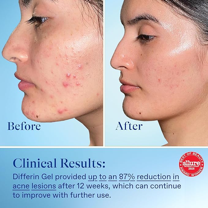 Differin Acne Treatment Gel, 30 Day Supply, Retinoid Treatment for Face with 0.1% Adapalene, Gentle Skin Care for Acne Prone Sensitive Skin, 15g Pump (Packaging May Vary)