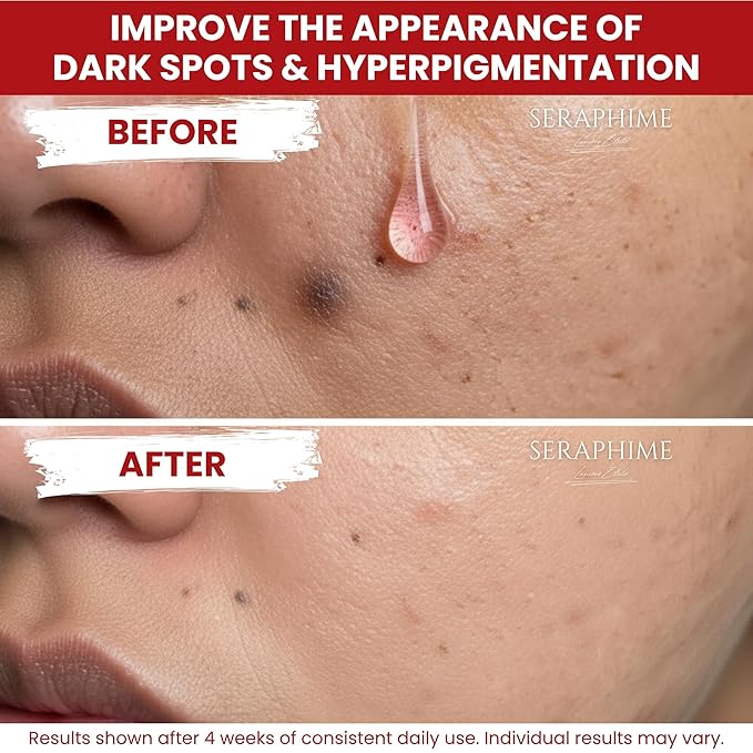 Tranexamic Acid TXA 4% + Niacinamide 10% Serum – Discoloration Correcting Serum with Alpha Arbutin, Pro-Vitamin B5, Phloretin Dark Spot, Hyperpigmentation, Uneven Skin Tone Corrector 1 fl oz