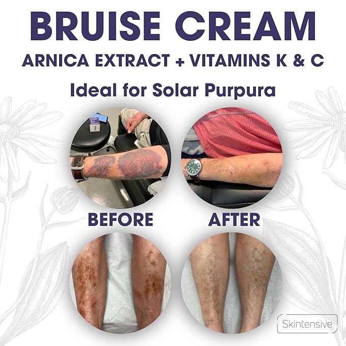 SKINTENSIVE Arnica Bruise Cream for Thin Skin - Moisturizing, Vitamin K C and E, Skin Renewal, 4 Oz [Jar May Vary]