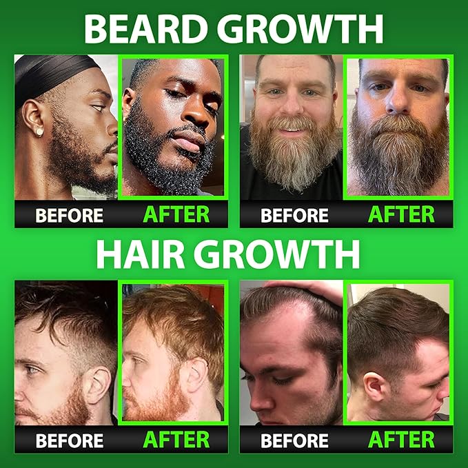 GROW Beard Oil Serum + Biotin Beard Growth Gummies – Beard Growth Kit for Men with 620,000mcg Biotin, Collagen, MSM & Keratin – Thickens Beard, Fills Patches & Supports Hair Growth
