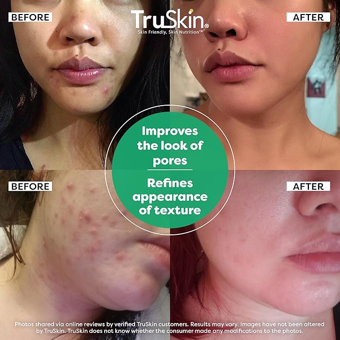 TruSkin Tea Tree Oil Acne Treatment for Face – Acne Serum – Improve the Appearance of Pores, Skin Tone for Smooth, Glowing Skin with Salicylic Acid, Vitamin C, Niacinamide & Retinol, 1 fl oz