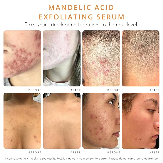 Almond Clear Level 1 Serum | Mandelic Acid Facial Serum for Acne, Folliculitis, Aging Skin, Ingrown Hairs, Dark Spots on Face, Chest, Butt, Back, Thighs, Arms | 4oz