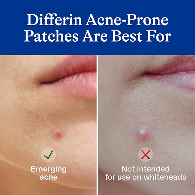 Differin Acne Patches, Pimple Patches for Acne Prone Skin, Formulated with Salicylic Acid and Centella, Fast Triple Action Power Patch for Day & Night, Dermatologist Tested, 36 Count (Pack of 12)