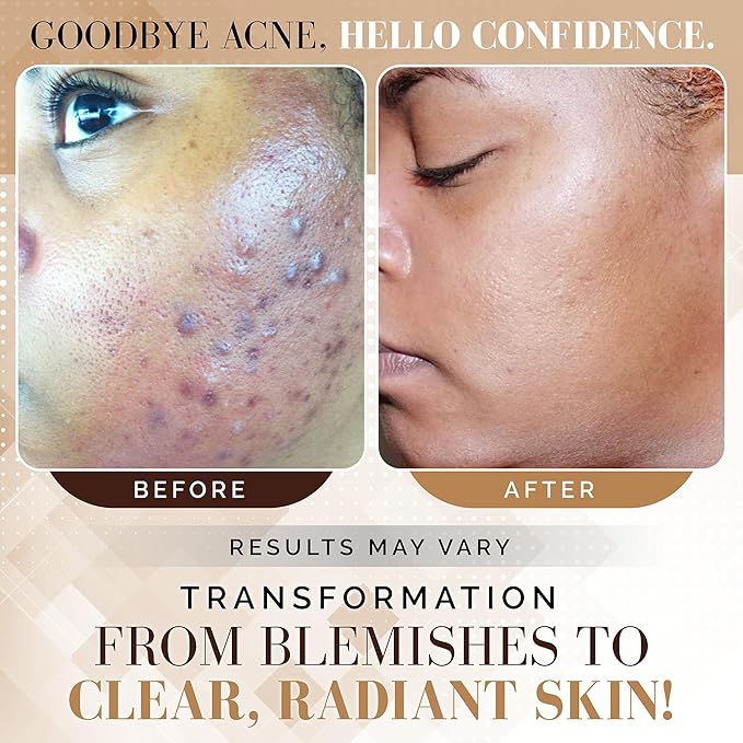 Noir D'or Acne Scar Treatment, Hyperpigmentation Treatment for Face, Normal to Oily Acne Skincare | Three Step Scar Repair Set for Acne Scars and Dark Spot Remover | Breakout Acne Treatment for Scars